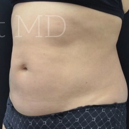 After Image: Abdomen - left-front-oblique