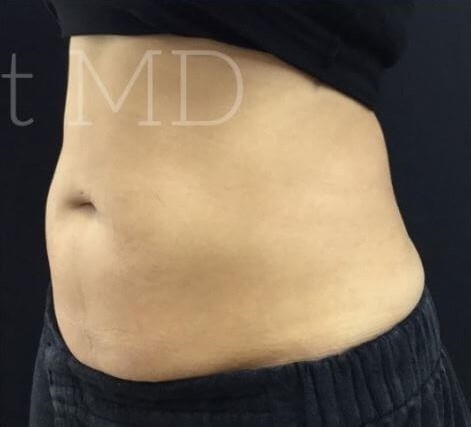 After Image: Abdomen - left-front-oblique