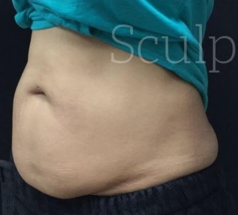 Before Image: Abdomen - left-front-oblique