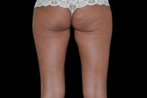 Before Image: Buttocks