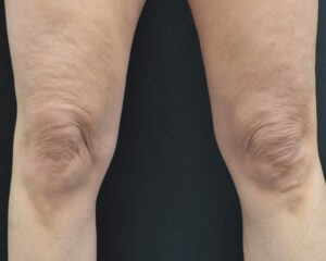 Before Image: Legs
