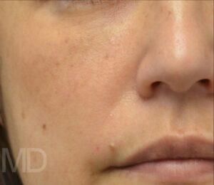 After Image: IPL Photofacial with BBL