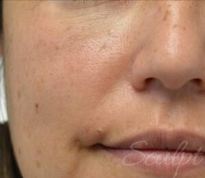 Before Image: IPL Photofacial with BBL
