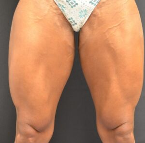 After Image: Front-Thighs