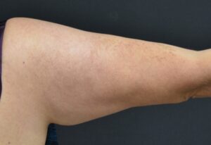 After Image: Triceps