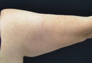 Before Image: Triceps