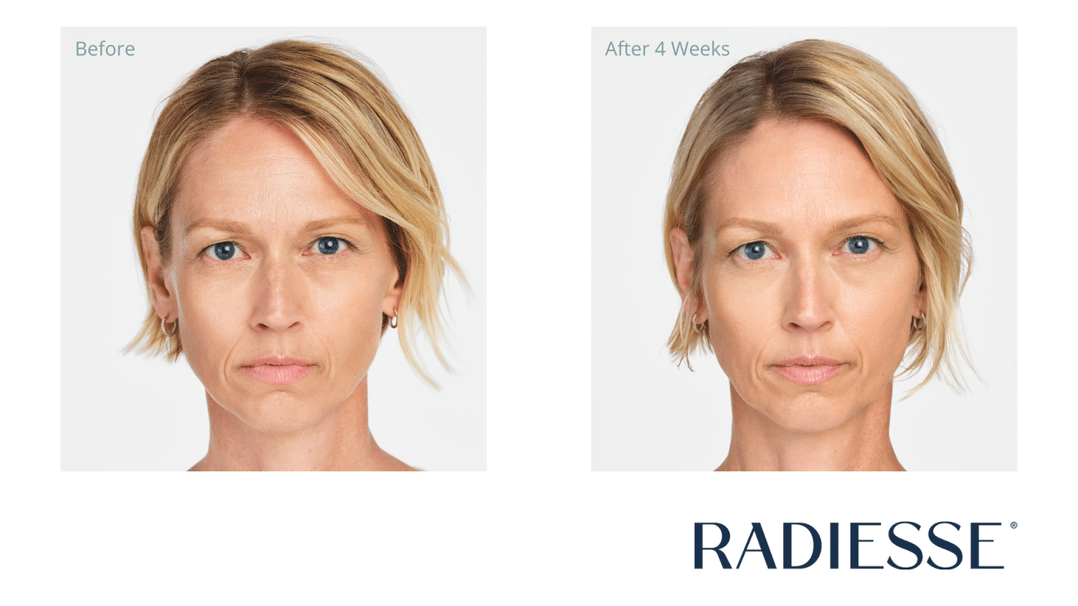 Radiesse 1536x864